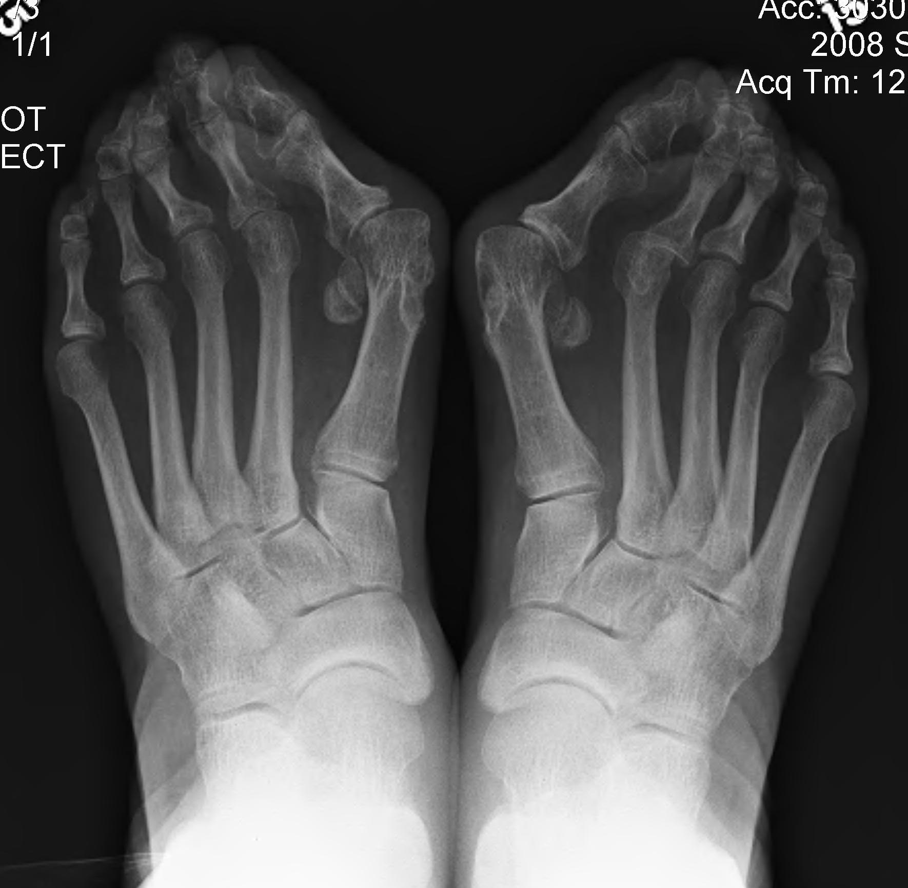 Hallux Valgus Severe